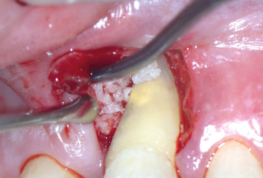 EPP for the treatment of a deep intrabony defect 