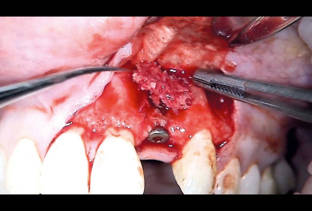 Simultaneous GBR and implantation using maxgraft® granules and autologous bone