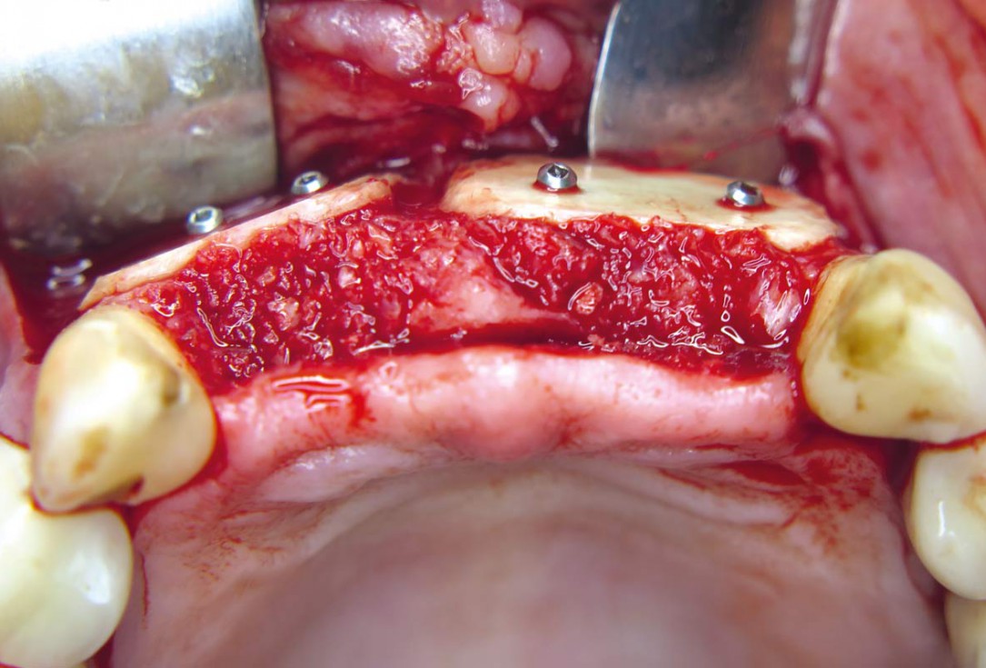 Three-dimensional augmentation with maxgraft® cortico - M.Sc. E. Kapogianni