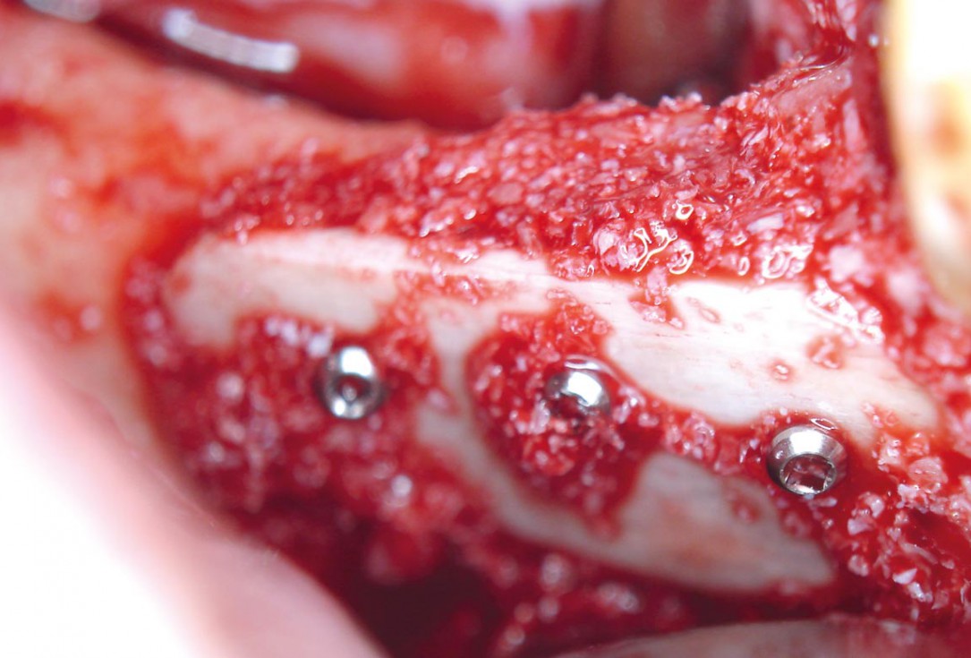 Horizontal ridge augmentation with maxgraft® cortico - M.Sc. E. Kapogianni