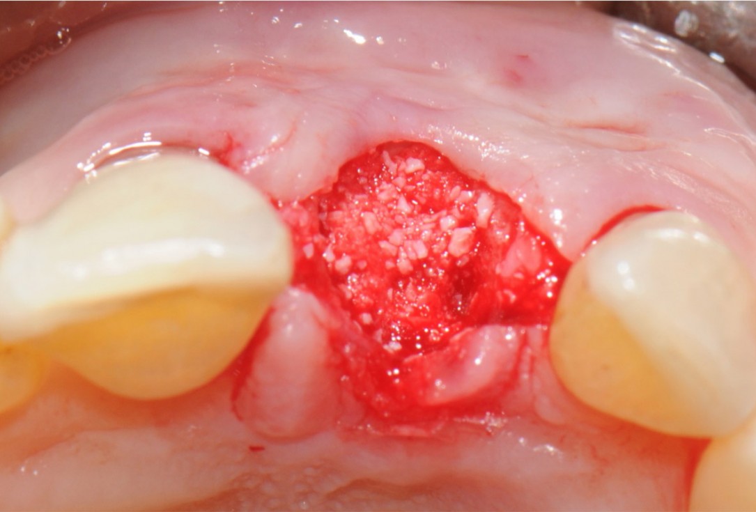 6/18 Tooth extraction and socket sealing with mucoderm® - Dr. A. Rossi