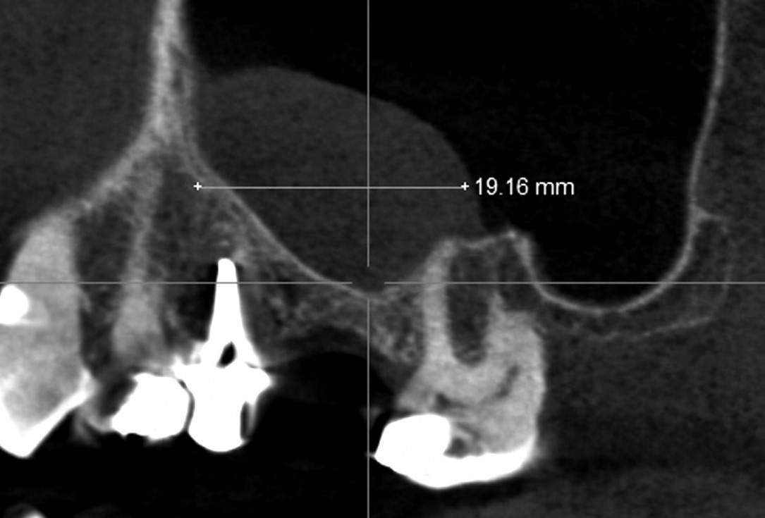 Maxillary sinus cyst removal using the Crocodile Technique and subsequent lateral sinus lift with cerabone®, maxgraft® and Jason® membrane - Dres. C. Scognamiglio and A. Perucchi 