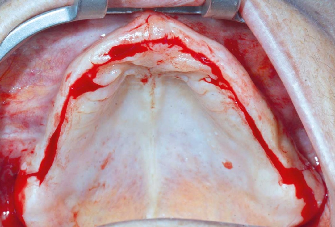 Full arch GBR using botiss cerabone®, maxgraft® and Jason® membrane with simultaneous implantation of 6 Straumann® implants - Dres. A. Signorio and G. Molina