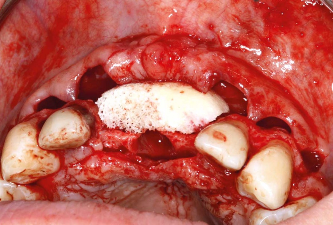 Ridge augmentation in the maxilla with maxgraft® bonebuilder in the aesthetic zone - Dr. M. Kristensen