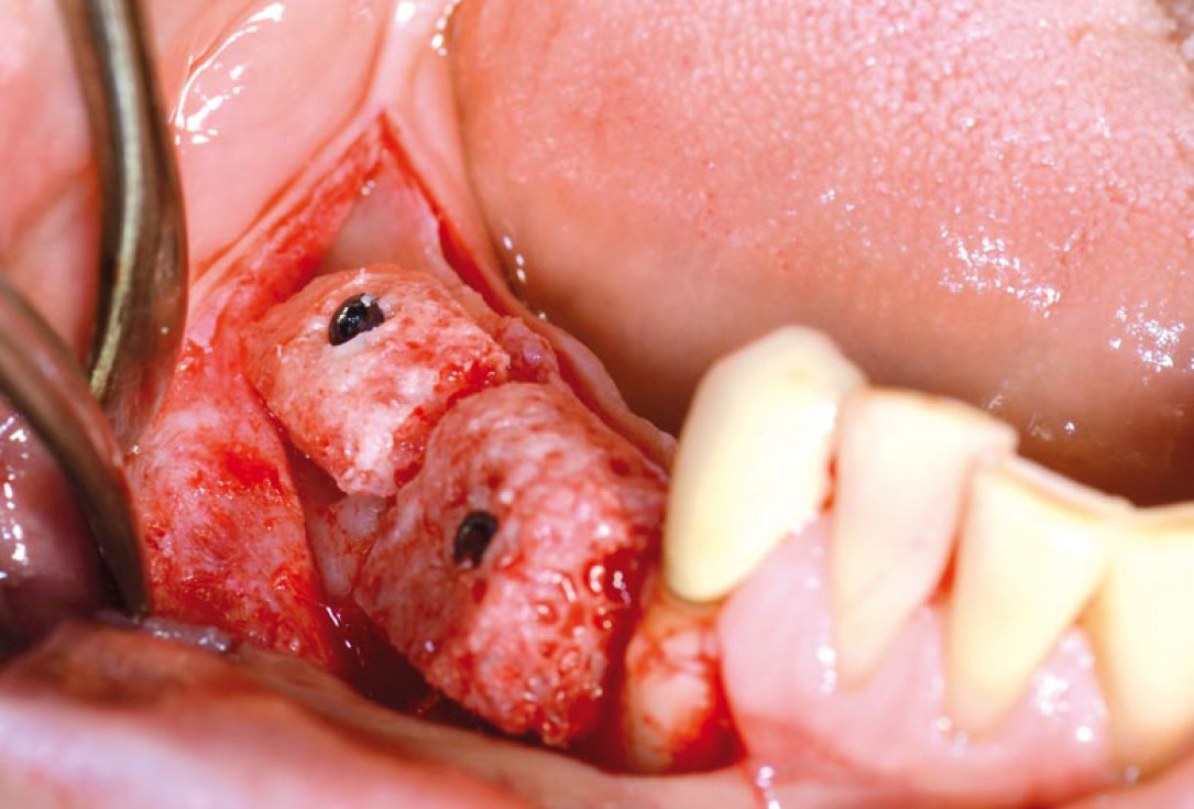 Block augmentation with maxgraft® in the mandible - PD Dr. Dr. F. Kloss