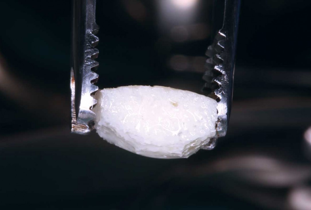 Block grafting in the aesthetic zone with maxgraft®, Jason® membrane and cerabone® - Dres. H. Maghaireh and V. Ivancheva