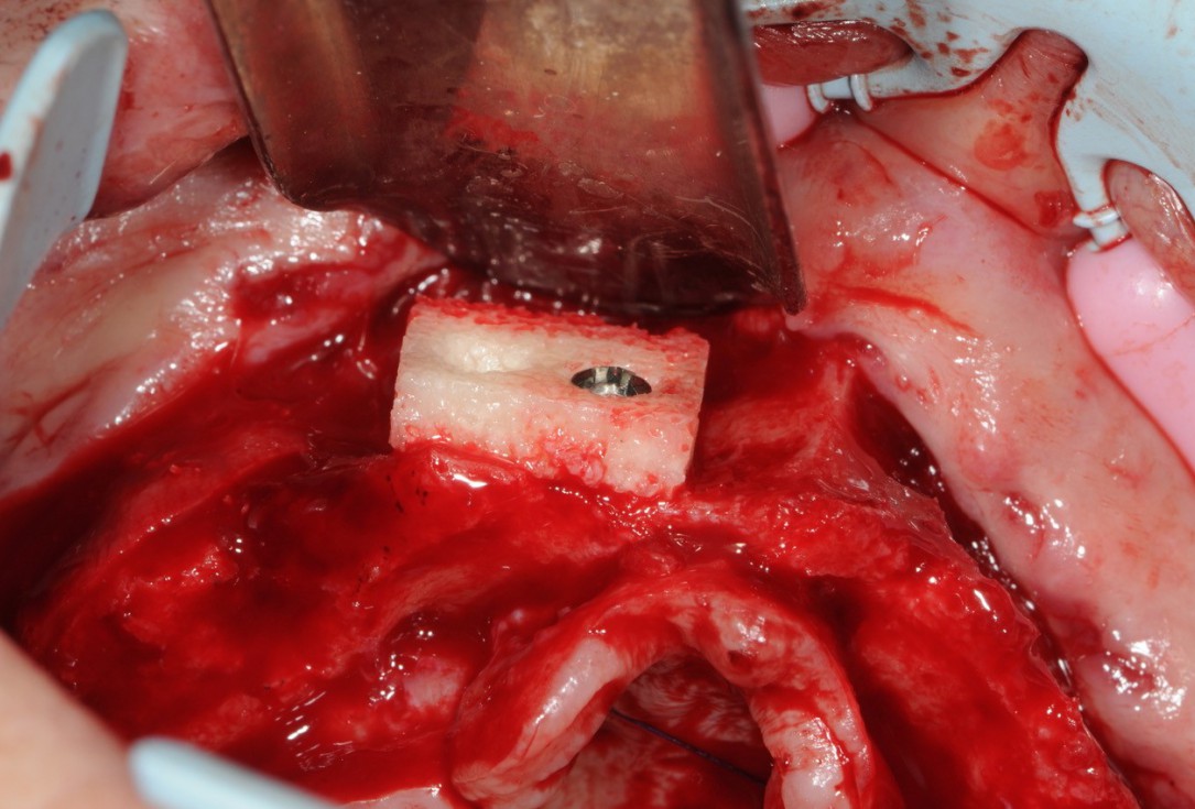 Reconstruction of maxillary ridge with maxgraft® block - Amit Patel