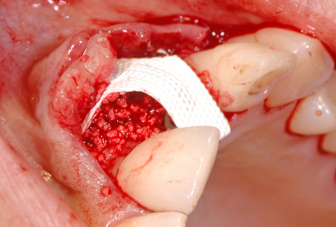 GBR together with soft tissue augmentation with mucoderm® and maxresorb® - Scherg