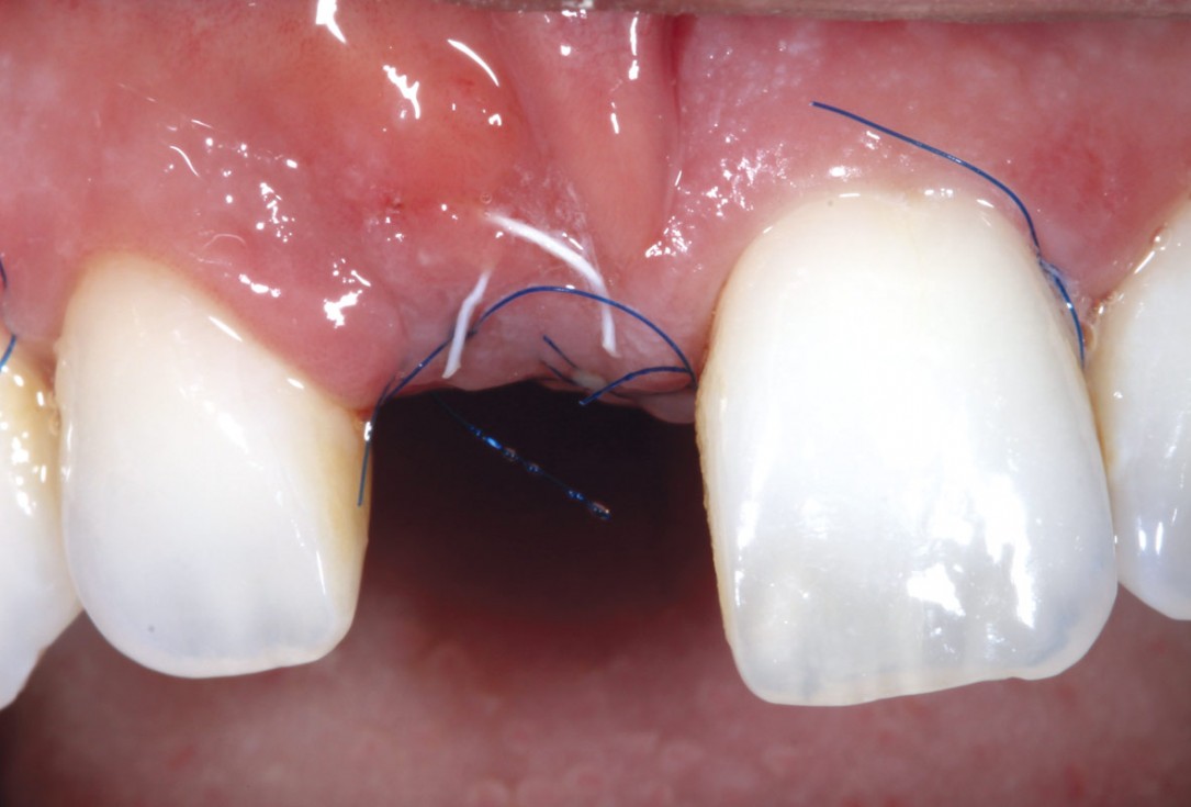 7/11 maxgraft® cortico at combined defect palatally and facially - Dr. K. Höckl