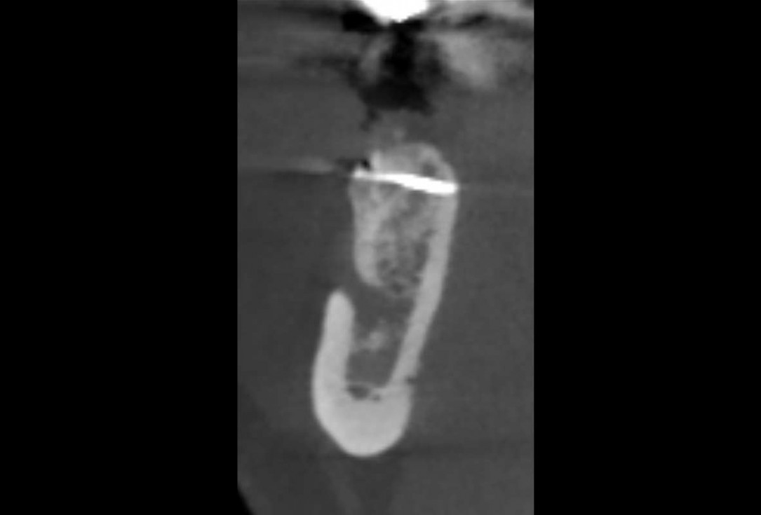 Reconstruction of a single tooth defect with the shell technique - Dr. Andoni Jones