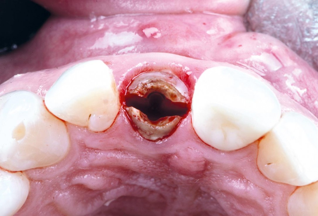Excellent aesthetic result of buccal augmentation with mucoderm® and maxgraft® after immediate implant placement - 3-years follow-up - Dr. A. Puišys 