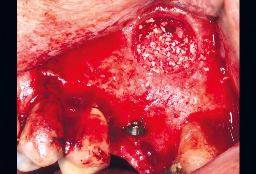Maxillary sinus cyst removal using the Crocodile Technique and subsequent lateral sinus lift with cerabone®, maxgraft® and Jason® membrane - Dres. C. Scognamiglio and A. Perucchi 