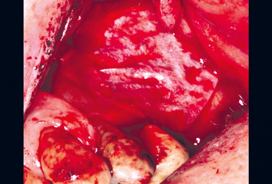 Maxillary sinus cyst removal using the Crocodile Technique and subsequent lateral sinus lift with cerabone®, maxgraft® and Jason® membrane - Dres. C. Scognamiglio and A. Perucchi 