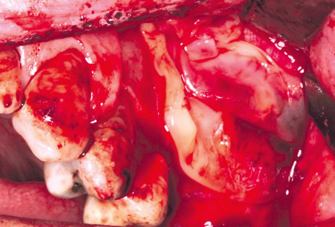 Maxillary sinus cyst removal using the Crocodile Technique and subsequent lateral sinus lift with cerabone®, maxgraft® and Jason® membrane - Dres. C. Scognamiglio and A. Perucchi 