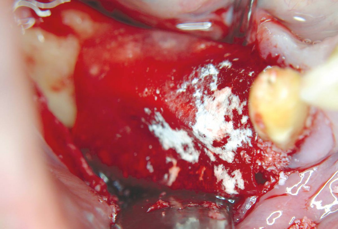 Horizontal ridge augmentation with maxgraft® cortico - M.Sc. E. Kapogianni