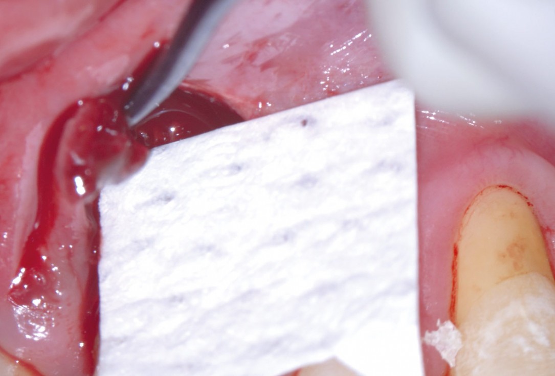 EPP for the treatment of a deep intrabony defect 