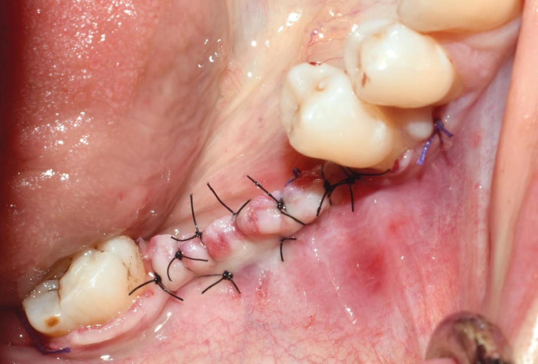 GBR with cerabone® and titanium reinforced PTFE membrane - DentalPro - A. Marchetta