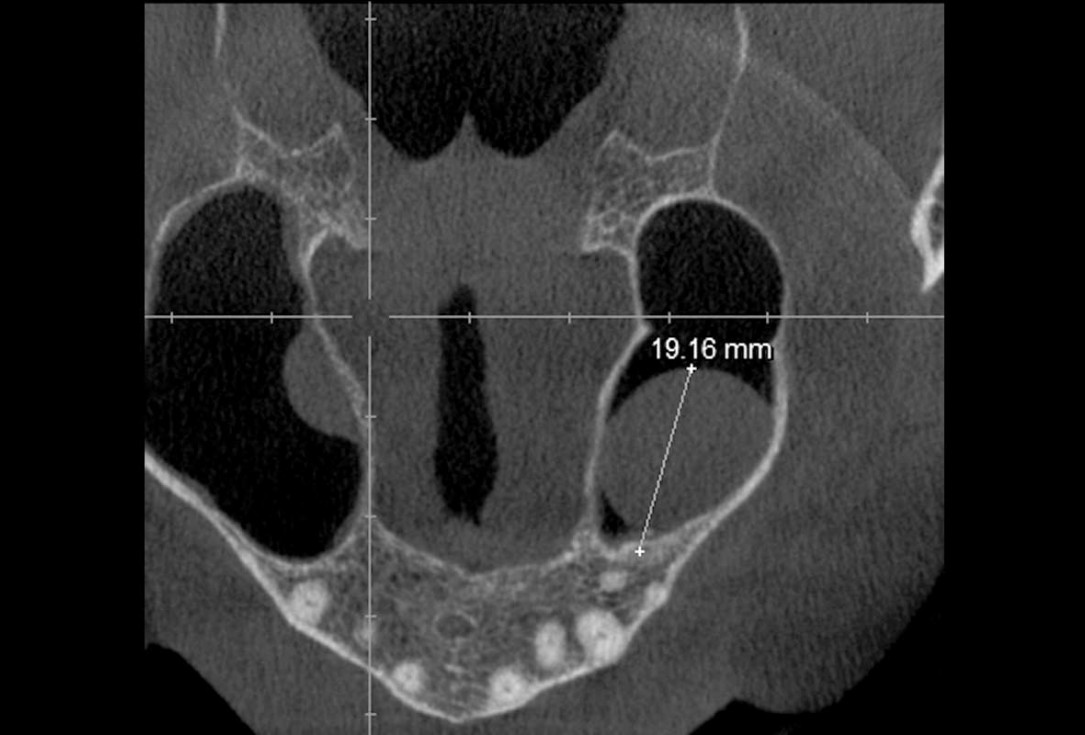 Maxillary sinus cyst removal using the Crocodile Technique and subsequent lateral sinus lift with cerabone®, maxgraft® and Jason® membrane - Dres. C. Scognamiglio and A. Perucchi 