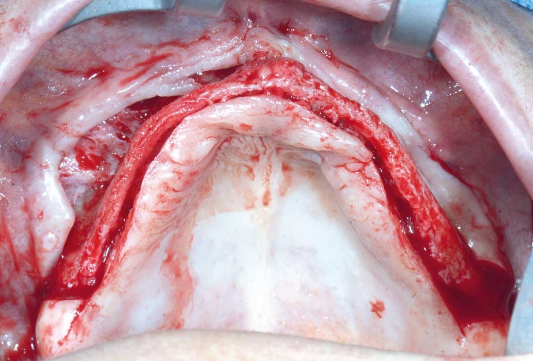 Full arch GBR using botiss cerabone®, maxgraft® and Jason® membrane with simultaneous implantation of 6 Straumann® implants - Dres. A. Signorio and G. Molina