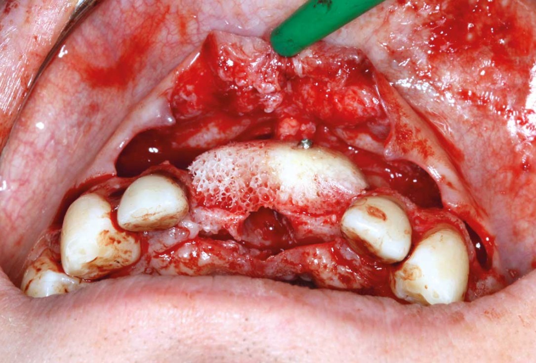 Ridge augmentation in the maxilla with maxgraft® bonebuilder in the aesthetic zone - Dr. M. Kristensen