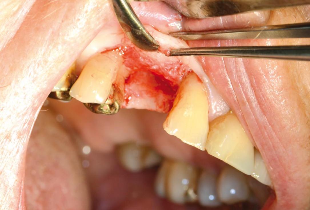 Block augmentation with maxgraft® in the maxilla - PD Dr. Dr. F. Kloss