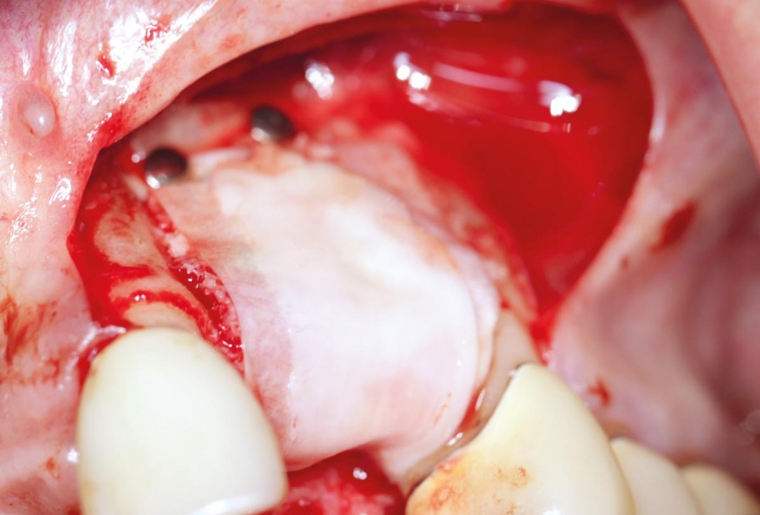 botiss maxgraft® bonebuilder for atrophic maxilla reconstruction - Clinical case