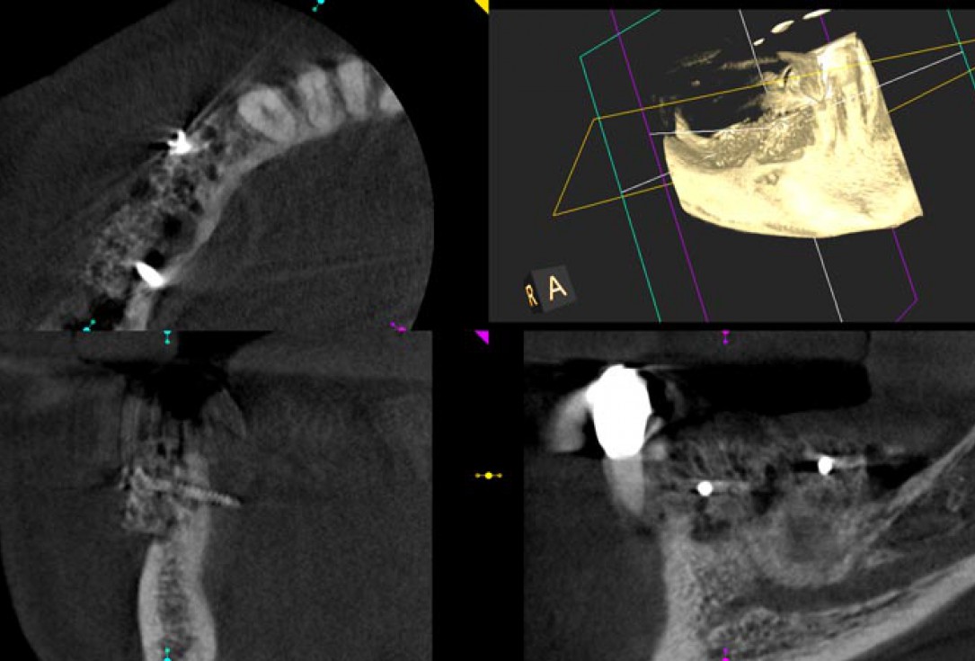 Block augmentation with maxgraft® in the mandible - PD Dr. Dr. F. Kloss