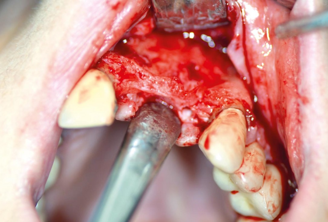 botiss maxgraft® bonebuilder for aesthetic zone reconstruction - Clinical case
