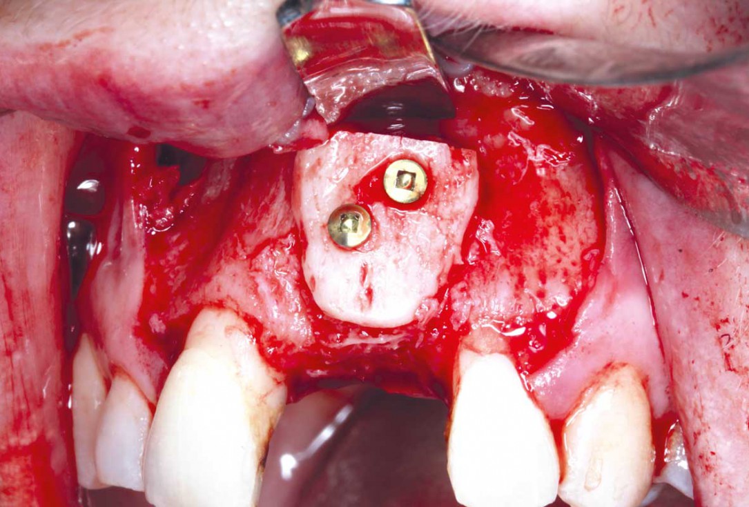Block grafting in the aesthetic zone with maxgraft®, Jason® membrane and cerabone® - Dres. H. Maghaireh and V. Ivancheva