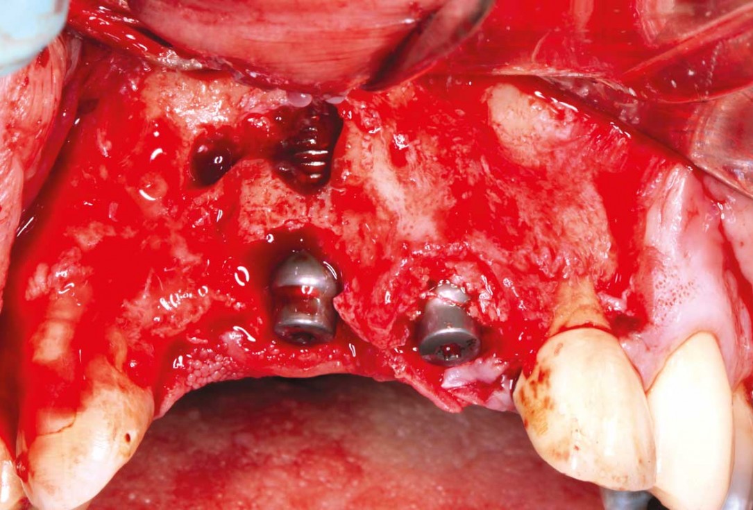 GBR and soft tissue augmentation with cerabone® and mucoderm® - H. Maghaireh & V. Ivancheva