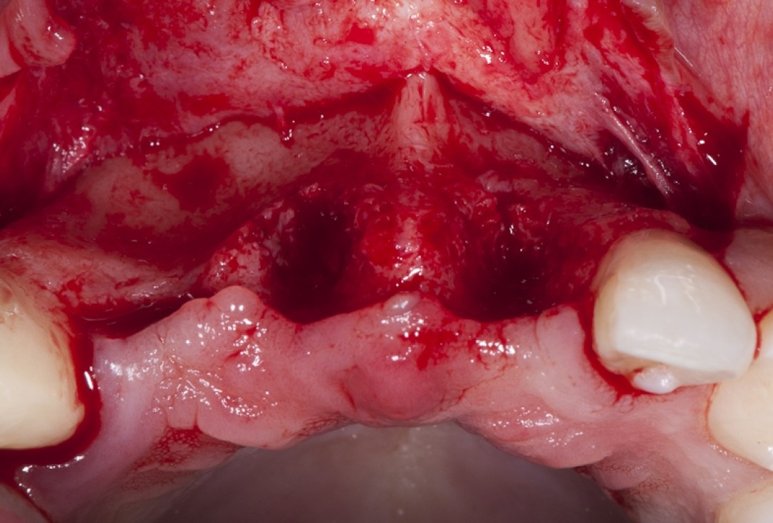 Block augmentation with maxgraft® block and mucoderm® - Dr. K. Chmielewski