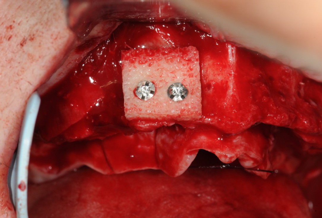 Reconstruction of maxillary ridge with maxgraft® block - Amit Patel