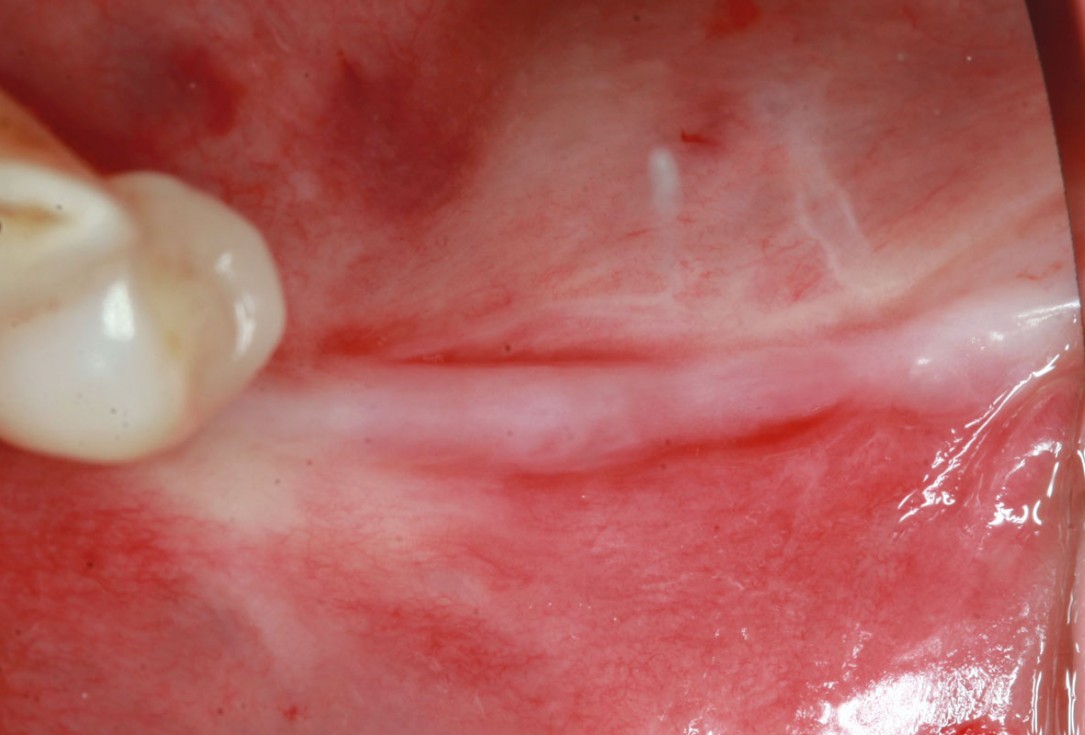 maxgraft® cortico at free-end situation in the mandible - J. Kielhorn