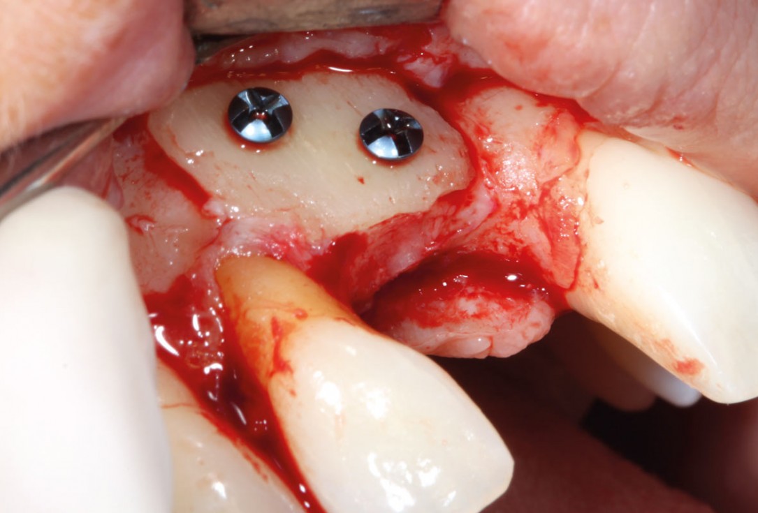 8/11 maxgraft® cortico at combined defect palatally and facially - Dr. K. Höckl