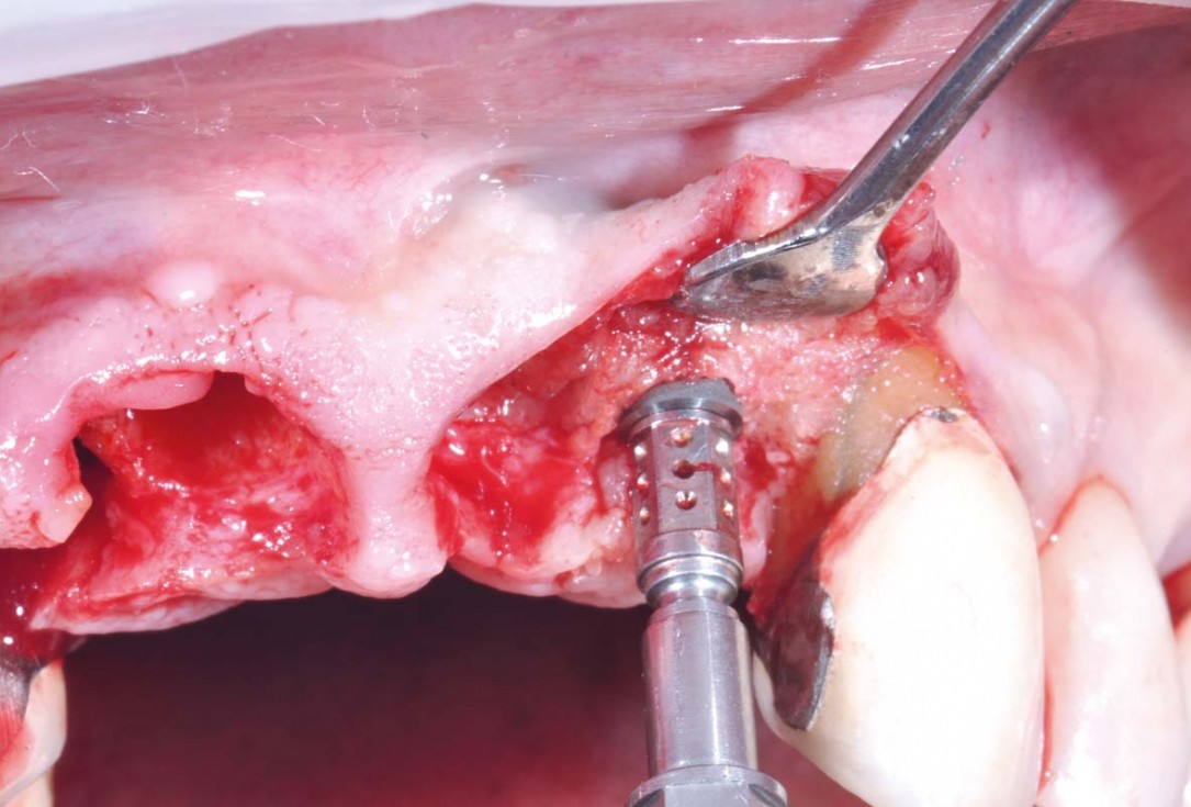 Hard and soft tissue management in immediate restoration