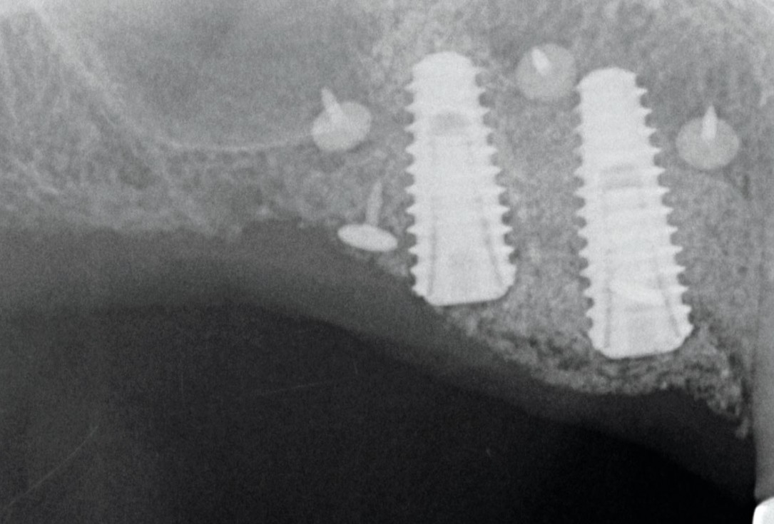 GBR with Jason membrane® and cerabone® - D. Fontana