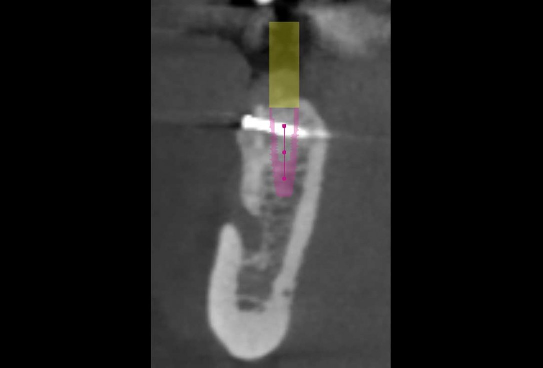 Reconstruction of a single tooth defect with the shell technique - Dr. Andoni Jones