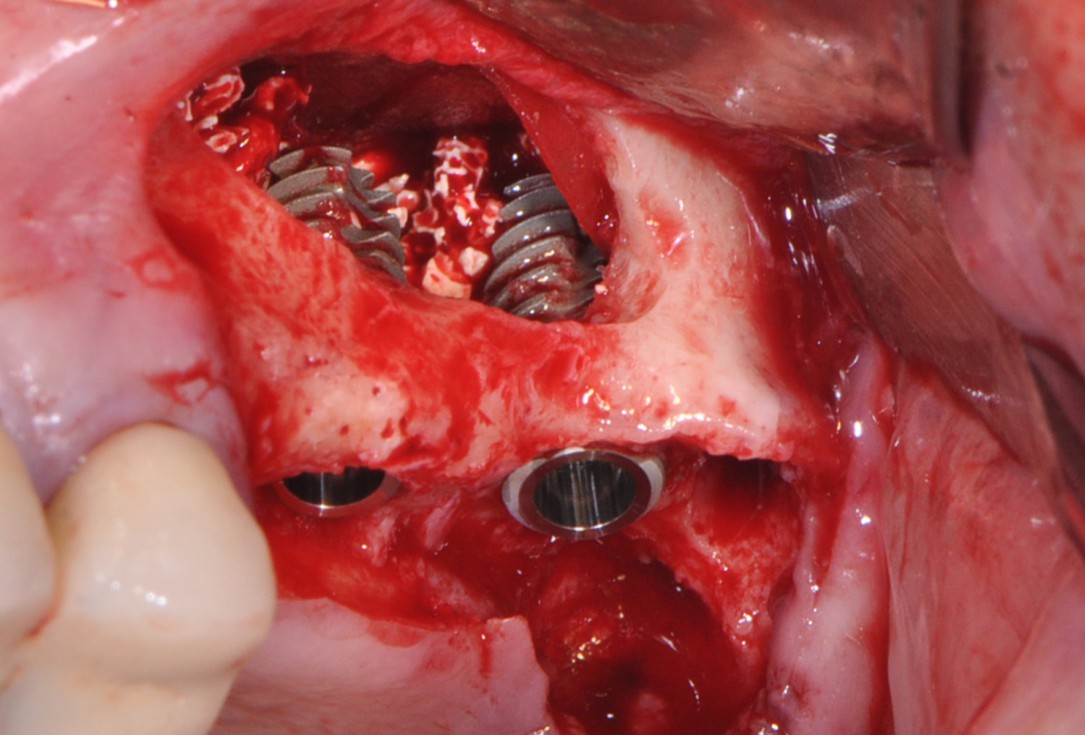 Sinus lift with simultaneous implantation with cerabone® and collprotect® membrane - clinical case Dr. Victor Kalenchuk
