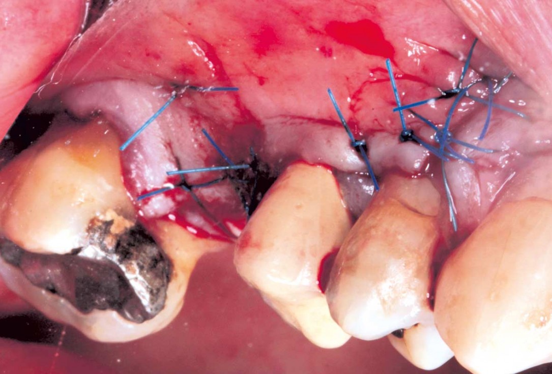 Maxillary sinus cyst removal using the Crocodile Technique and subsequent lateral sinus lift with cerabone®, maxgraft® and Jason® membrane - Dres. C. Scognamiglio and A. Perucchi 