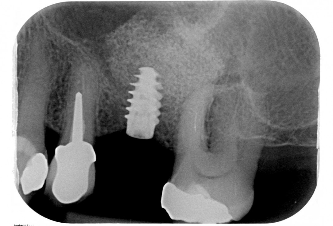 Maxillary sinus cyst removal using the Crocodile Technique and subsequent lateral sinus lift with cerabone®, maxgraft® and Jason® membrane - Dres. C. Scognamiglio and A. Perucchi 