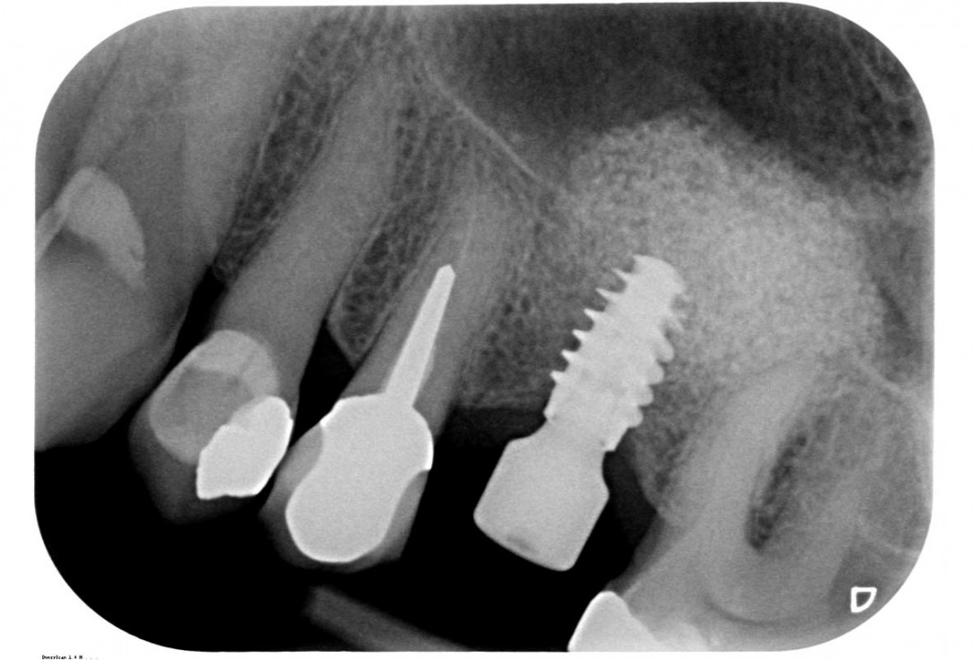 Maxillary sinus cyst removal using the Crocodile Technique and subsequent lateral sinus lift with cerabone®, maxgraft® and Jason® membrane - Dres. C. Scognamiglio and A. Perucchi 