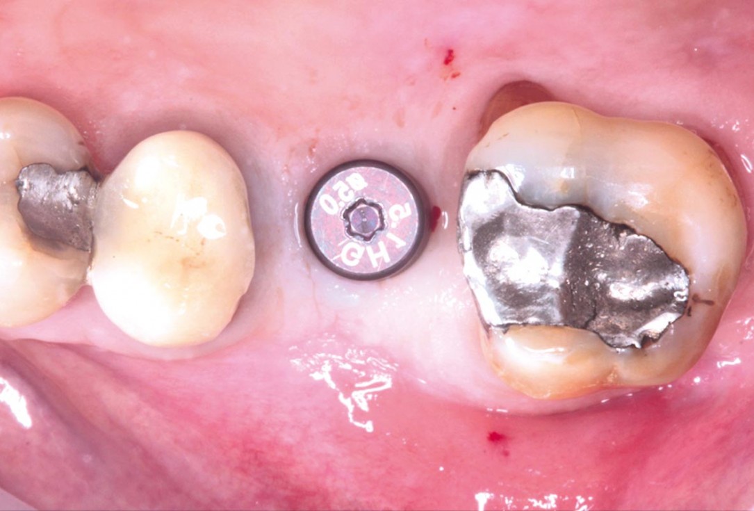 Maxillary sinus cyst removal using the Crocodile Technique and subsequent lateral sinus lift with cerabone®, maxgraft® and Jason® membrane - Dres. C. Scognamiglio and A. Perucchi 