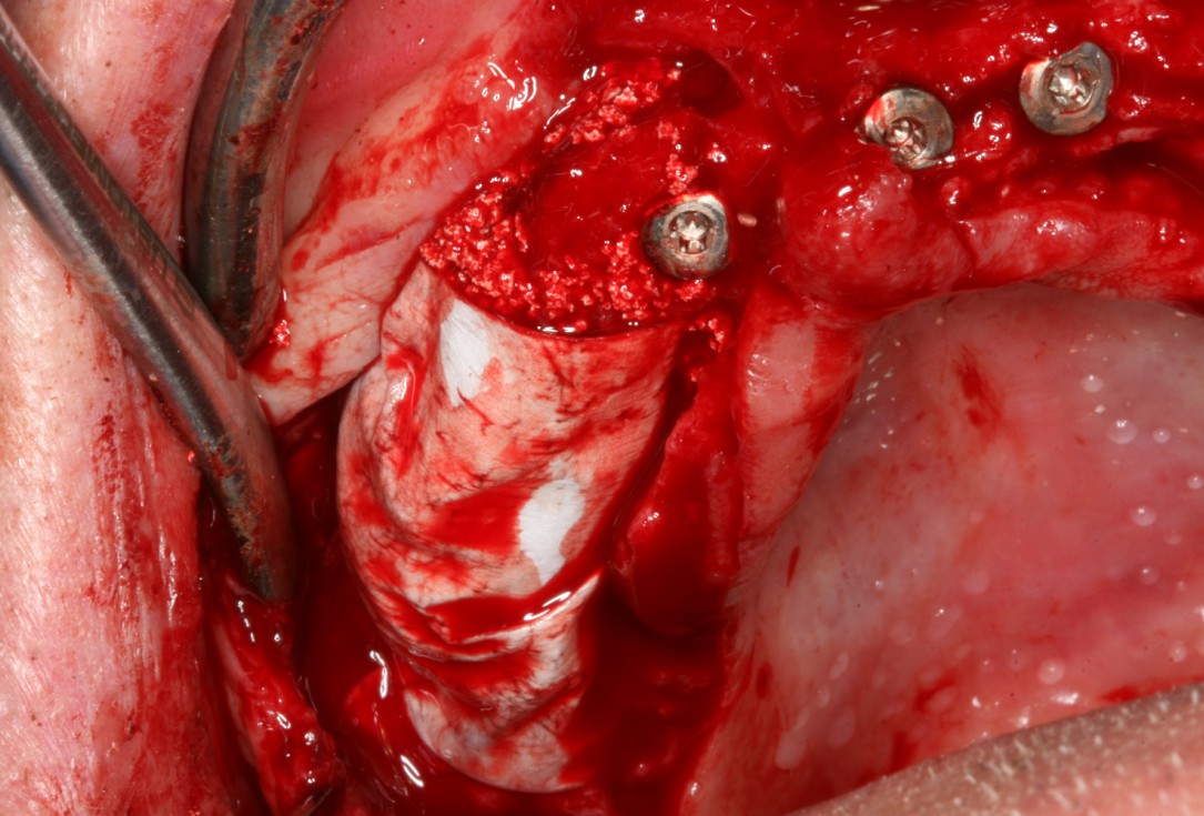 05/10 botiss maxresorb® and collprotect® membrane for bone splitting - case by Dr J Neugebauer