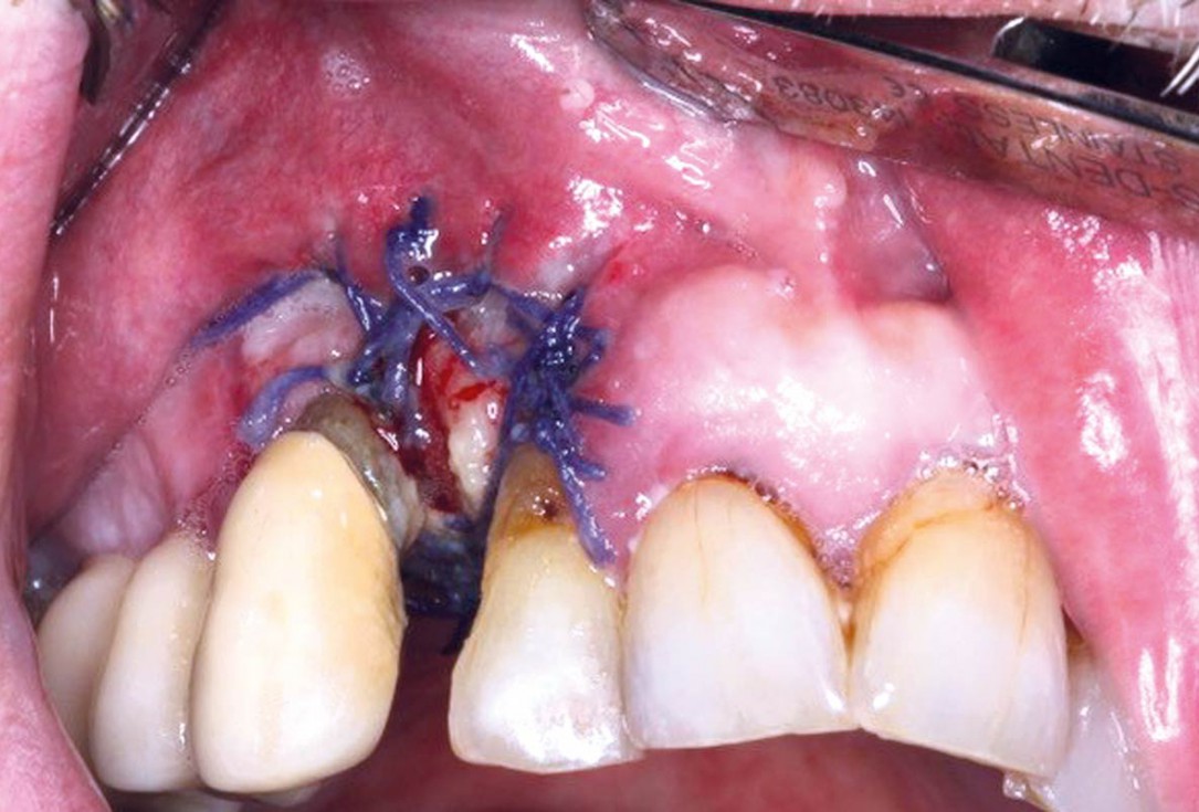 Regeneration with mucoderm® after fibroma resection