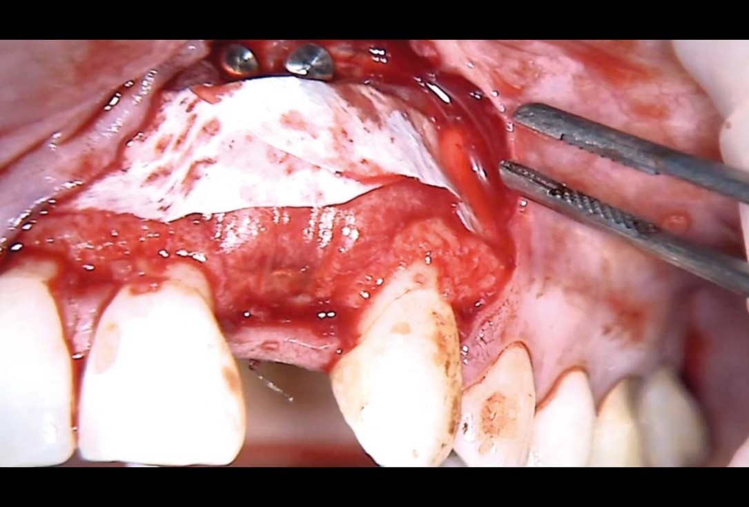 Simultaneous GBR and implantation using maxgraft® granules and autologous bone