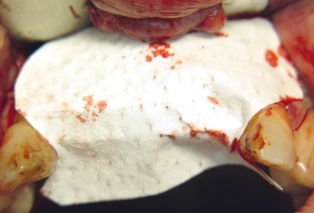 Three-dimensional augmentation with maxgraft® cortico - M.Sc. E. Kapogianni