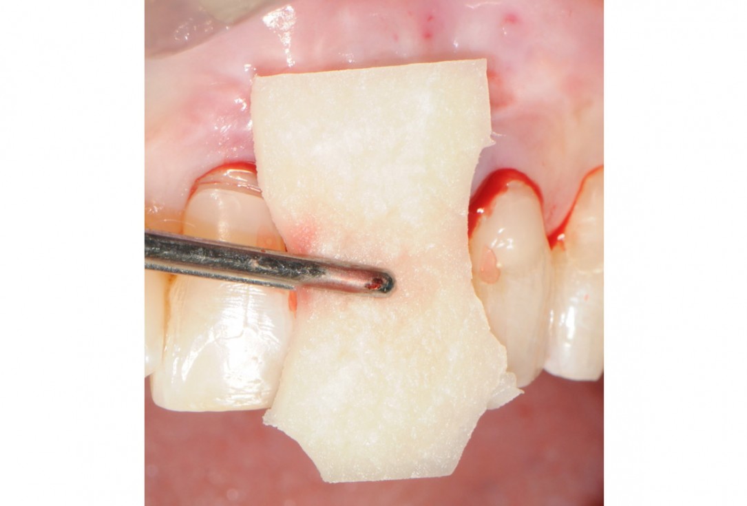 8/18 Tooth extraction and socket sealing with mucoderm® - Dr. A. Rossi