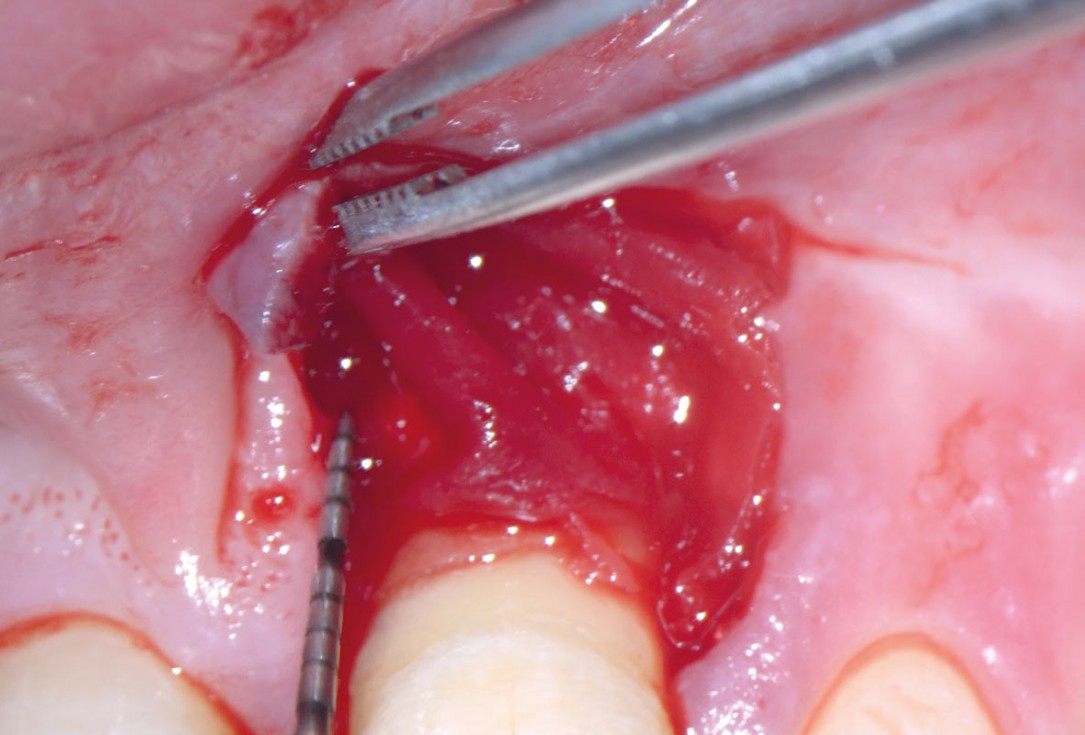 EPP for the treatment of a deep intrabony defect 