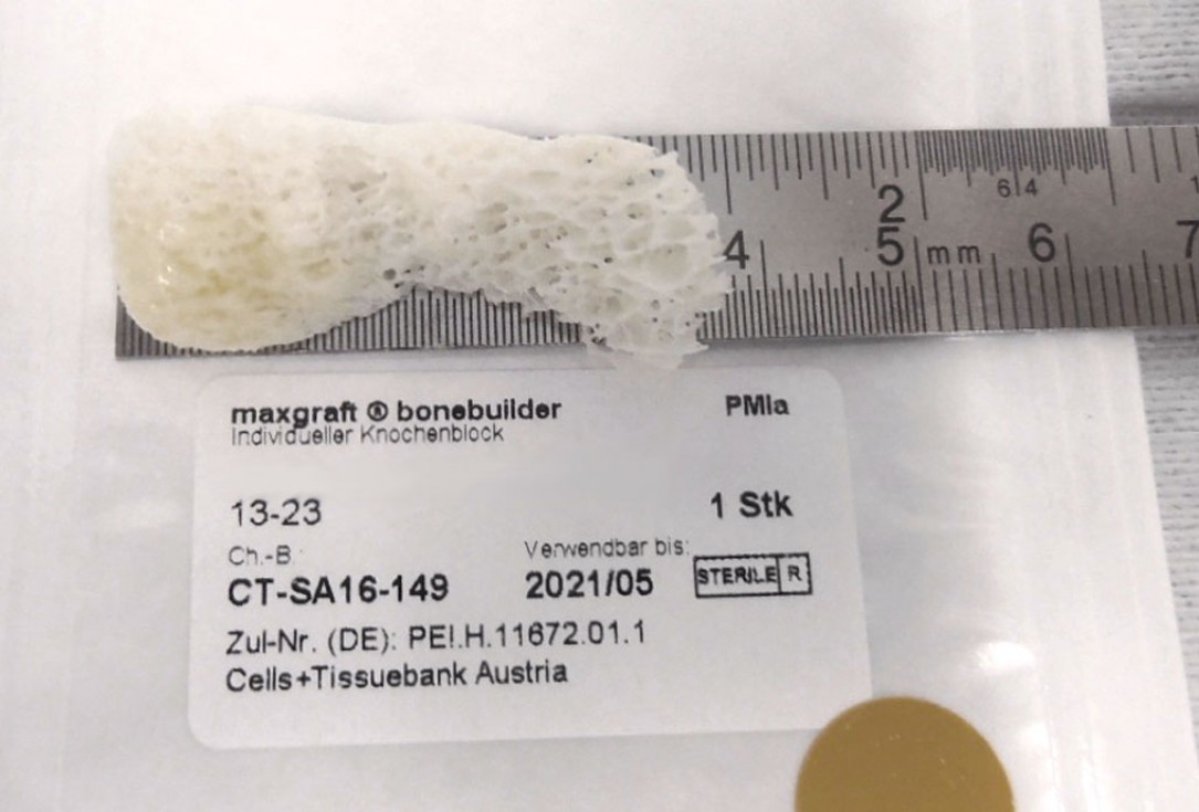 botiss maxgraft® bonebuilder aesthetic reconstruction - Clinical case