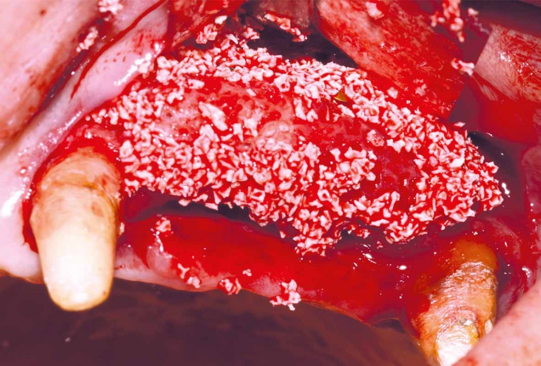 Reconstruction of Anterior Maxilla with maxgraft® bonebuilder – Dr. B. Han